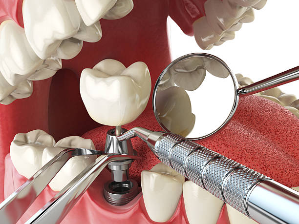 Best Emergency Wisdom Tooth Extraction in Kgsford Heights, IN